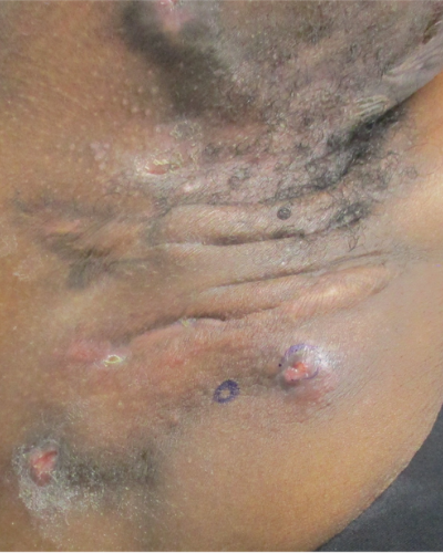 Severe case of hidradenitis suppurativa