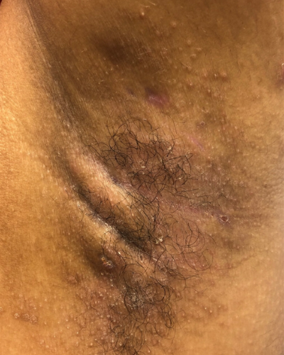 Moderate case of hidradenitis suppurativa