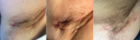 Hidradenitis Suppurativa