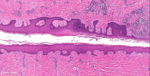 Genetic Variants Associated with Hidradenitis Suppurativa